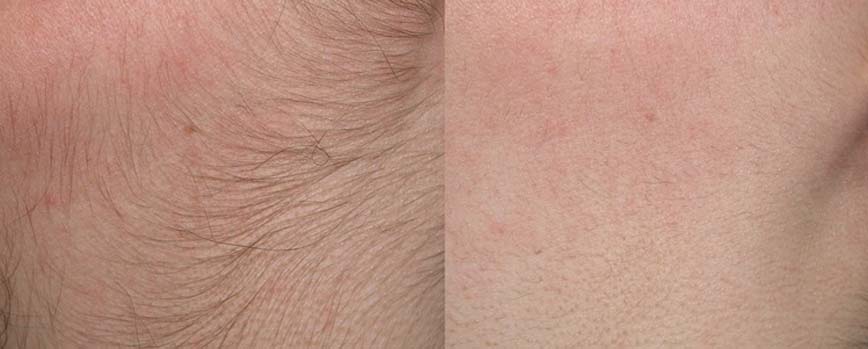 ¿Qué es el vello facial en mujeres?