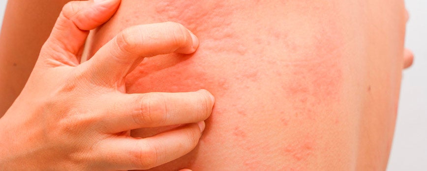 Urticaria