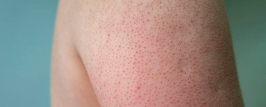 ¿Qué es la queratosis pilaris?