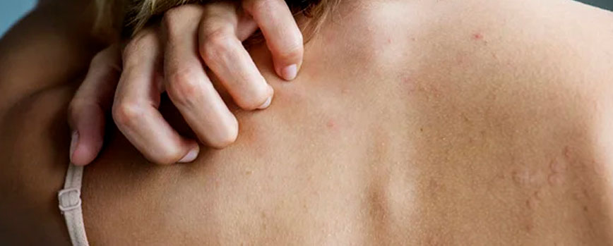 ¿Por qué sale el sarpullido en la espalda?