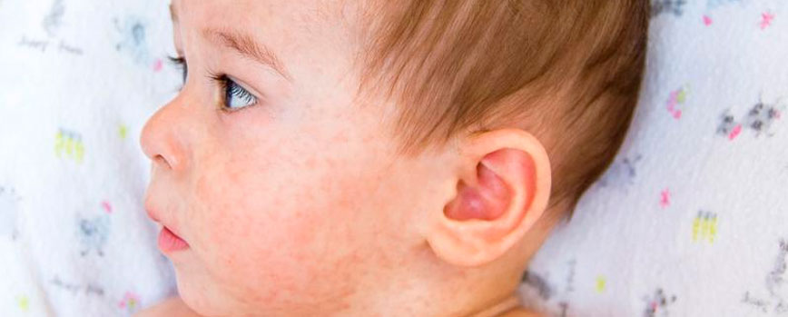 Estos son los tipos de sarpullidos más habituales en los bebés y niños pequeños