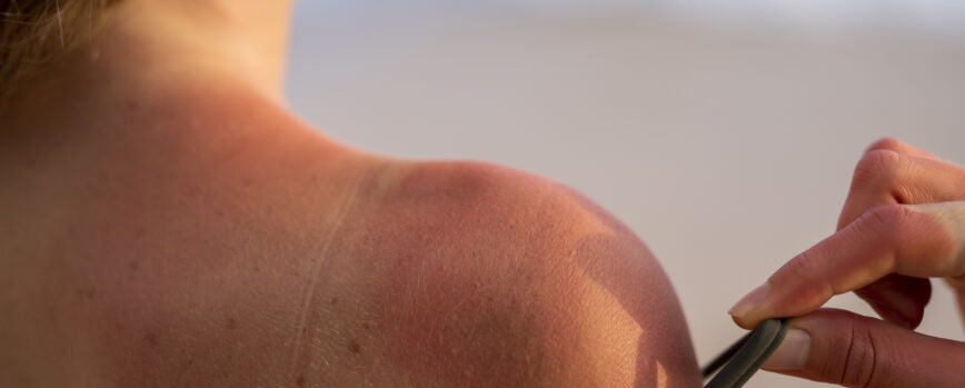 Detalles de la piel quemada por el sol de una mujer del sol de la playa