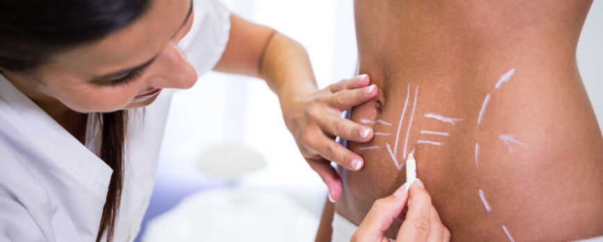 Cirujano dibujando líneas en el abdomen de la mujer para la liposucción y la eliminación de la celulitis