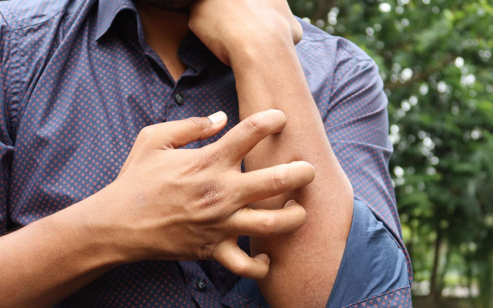 Un hombre con una camisa azul rascándose el brazo al aire libre, destacando la irritación de la piel.